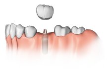 Ein Zahn fehlt: Ein Implantat hat gegenüber einer Brücke den Vorteil, dass Nachbarzähne nicht be- schliffen werden müssen.